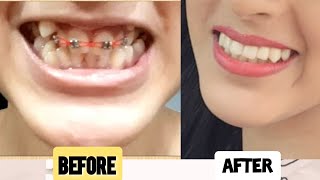 DentalTeeth transformation  Before and after braces removal  Braces timelapse [upl. by Rabin]