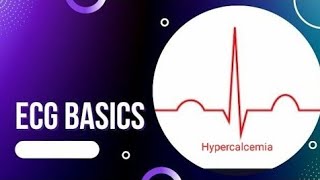 ECG Basics  ECG Changes in Hypercalcemia  Causes of Hypercalcemia [upl. by Liberati]