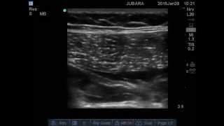 Ultrasound Guided Ankle Block [upl. by Enieledam]