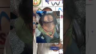 Hair transplant review hairlinetransplant mathurahairhairtransplantmathurahairlinetransplantagra [upl. by Andrus]