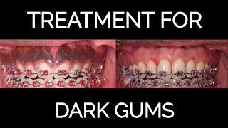 Gum Bleaching Procedure for Black Gums 2018 [upl. by Koosis107]