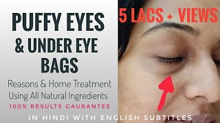 PUFFY EYES amp UNDER EYE BAGS  Reasons amp Treatment Using Natural Ingredients  100 Results Gaurantee [upl. by Noloc964]