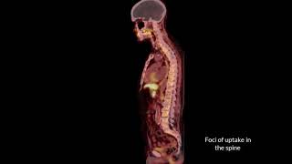 Osseous Metastatic Prostate Cancer  PETCT Scan  Charter Radiology [upl. by Studley]