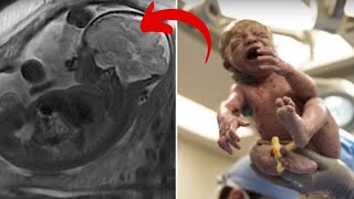 This Mom Gave Birth To A Healthy Baby But When Doctors Saw Her Placenta They Left It Inside Her [upl. by Leid213]