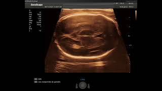 Evaluación de un feto de 24 semanas con el transductor lineal del Sonoscape P40 Elite [upl. by Ydnih]