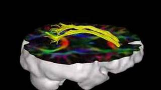 Brain Fiber Tractography [upl. by Xerxes]