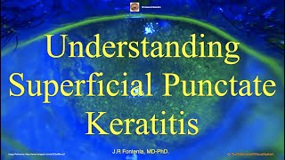 Understanding Superficial Punctate Keratitis [upl. by Enahsal]