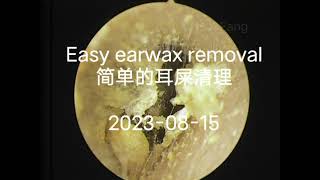 Easy earwax removal（简单的耳屎清理）20230816 [upl. by Shurwood]