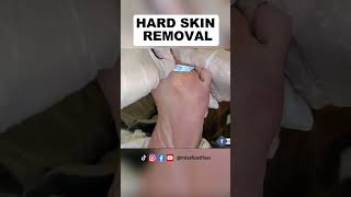 Hard skin removal  Miss Foot Fixer [upl. by Woodley]