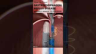 Gastroesophageal Reflux Disease GERD Treatment shorts tutorial medical animation surgmedia [upl. by Jacquelyn]