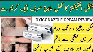 Xirconi cream uses in Urdu  oxiconazole nitrate 1 Benifits  xirconi cream  dosage sideeffects [upl. by Emmeline417]