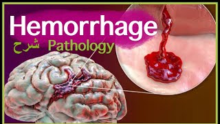 Pathology  Hemorrhage  Blood Hemodynamic disorders شرح باثو [upl. by Zeidman]