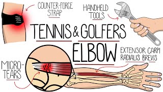 Understanding Tennis Elbow and Golfers Elbow Lateral amp Medial Epicondylitis [upl. by Aetnuahs699]