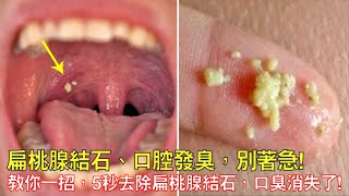 扁桃腺結石、口腔發臭，別著急！教你一招5秒去除扁桃腺結石，口臭消失了！口腔清潔、無異味！ [upl. by Yank199]