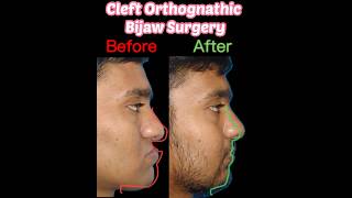 World Best and Free for the Poor Orthognathic Jaw Surgery GSR hospital hyderabad telangana india [upl. by Ahsinoj269]