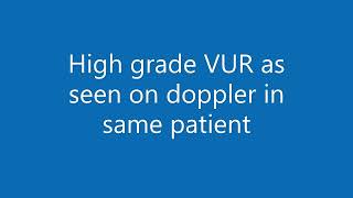 High grade vesicoureteral reflux VUR as seen on B mode and doppler [upl. by Eelatsyrc605]