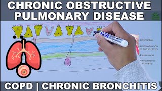 Chronic Obstructive Pulmonary Disease  COPD [upl. by Paderna]