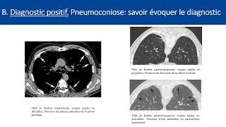 Item 210 Pneumopathie infiltrante diffuse [upl. by Enwad]