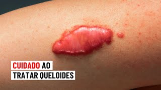 Cuidado ao tratar queloides ⚠ [upl. by Olocin]