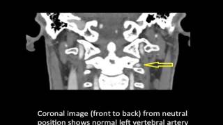 Vertebrobasilar Artery Syndrome  Bowhunters Syndrome  Colorado Spine Surgeon [upl. by Tnemelc]