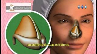 O QUE É RINOPLASTIA Video Como é feita Dói Quais as indicações e riscos [upl. by Aztinad581]