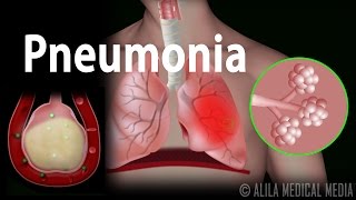 Pneumonia Animation [upl. by Kurzawa]