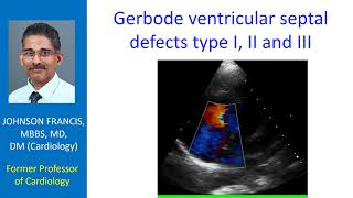 Gerbode ventricular septal defects type I II and III [upl. by Persson812]