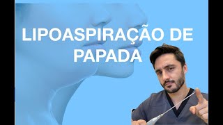 LIPOASPIRAÇÃO DE PAPADA  Emagrecendo o rosto [upl. by Aronoel]