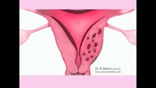 Adenomyosis  CRASH Medical Review Series [upl. by Lyford28]