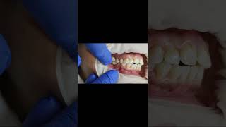 2 unit lower molar implant bridge PMMA for basal dental implants fitting video shorts [upl. by Fowkes]