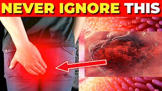 Critical Colon Cancer Symptoms You Should Never Ignore [upl. by Arlyne]