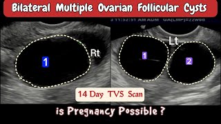 TVS Ultrasound  Bilateral multiple Ovarian Follicular Cysts [upl. by Luttrell]