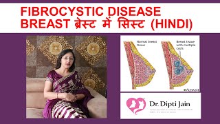 FIBROCYSTIC DISEASE BREAST ब्रेस्ट में सिस्ट HINDI [upl. by Olshausen221]