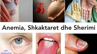 ANEMIA Shkaqet dhe Sherimi  anemia mjekesi shendetshem irondeficiency semundjet [upl. by Aicilram]