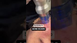 Acne Scars Treatment Using Scarlet [upl. by Lig710]