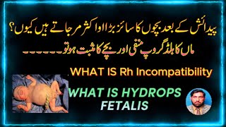 What is Hydrops Fetalis ماں کا بلڈ گروپ منفی ہو اور بچے کا مثبت ہو تو بچے پر کیا اثرات ہوتے ہیں۔ [upl. by Auqenes]