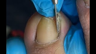 Huge ingrown toenail removal [upl. by Jillayne505]