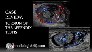 Ultrasound of Torsion of the Appendix Testis [upl. by Eselahc91]