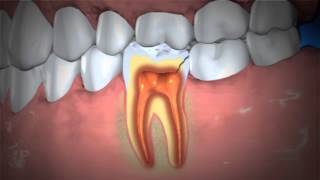 Treatment of Abscessed Teeth [upl. by Madelene317]