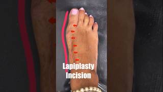 Lapiplasty™ vs MIS bunion Surgery shorts [upl. by Hamer]