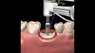 Step by step dental implant surgery Gary R OBrien DDS [upl. by Assetak540]