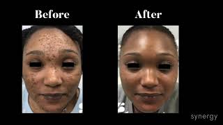 Two Faced Cyspera for Pigmentation Skincare on Two Types of Skin with Medical Aesthetician Emily T [upl. by Kristi]