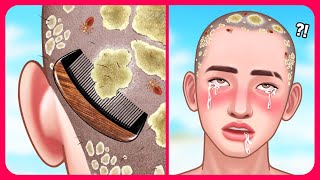 Athletes Scalp Psoriasis Dandruff Flakes and Lice Removal🪮 [upl. by Nevad816]