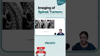 Imaging of Spinal Tumors By Dr Zainab Vora  Radiology Residency  Conceptual Radiology [upl. by Nosille]