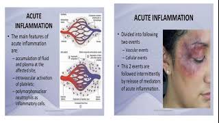 Inflammation  Contraction And Retraction Of Endothelial Cells  Dr Sana Khalid [upl. by Frye294]