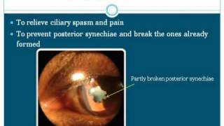 Ophthalmology  Uvea Class4 Management of uveitis Part1 [upl. by Peters674]