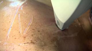 Lightsheer Laser Hair Removal [upl. by Yerffej]