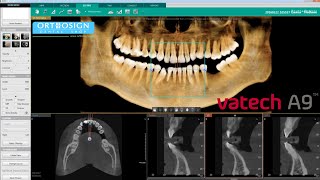 Radiografía Panorámica 3D Cone Beam en Vatech A9  Panorámico  Ceph  Orthosign [upl. by Rector]