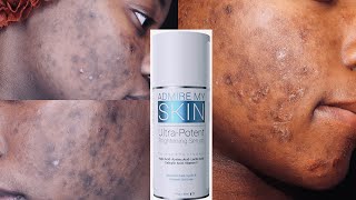 I TRIED ADMIRE MY SKIN ON MY HYPERPIGMENTATION  HONEST REVIEW [upl. by Nairrad]