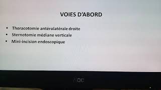 CHIRURGIE DE LA VALVE MITRALE VOIES DABORD ET EXPOSITION D LA MITRALE [upl. by Eliot511]